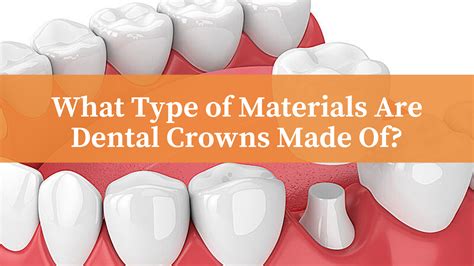 Types Of Dental Crown Materials - Design Talk