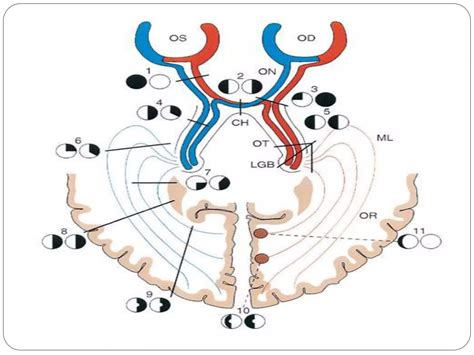Image result for Visual Pathway Defects
