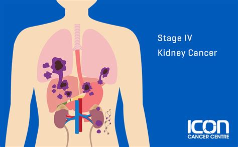 Cancer Kidney Stage 4