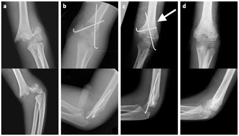 Supracondylar Fractures Of The Humerus