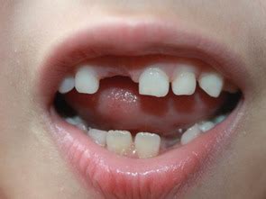 天津牙齿矫正刘承正畸案例解析：在牙齿矫正中如何精准的设计前牙转矩角度 - 哔哩哔哩