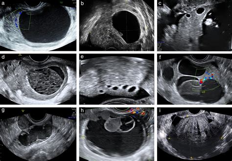 Ovarian Torsion Sonography