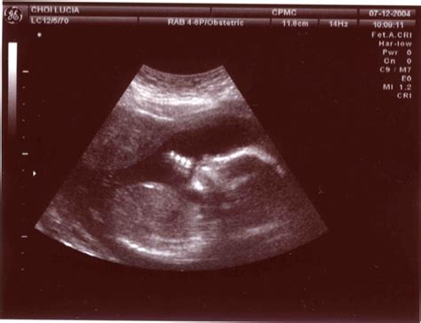 Ultrasound 的图像结果