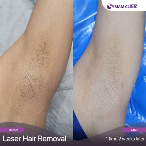 Hair Removal Laser Before and After Photos - Siam Clinic Thailand
