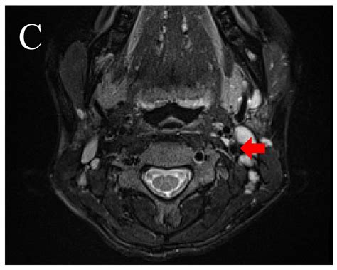 A Spontaneous Extracranial Internal Carotid Artery Dissection with ...