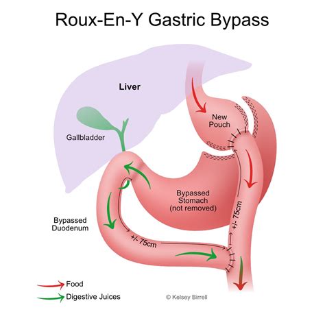 Roux-En-Y Gastric Bypass - Toowoomba Bariatric Surgery, South-East QLD