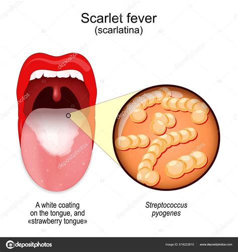 Scarlet Fever Mouth White Coating Tongue Strawberry Tongue Close Streptococcus Stock Vector by ...