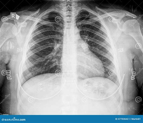 Chest X Ray Images Of Bronchitis at Mitchell Cushing blog
