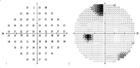 Image result for Peripheral Visual Field Defect