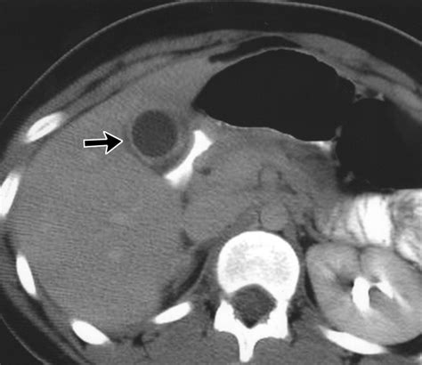 fitz hugh curtis症候群診断: fitz hugh curtis症候群 造影ct – TJTO