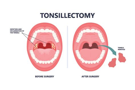 Tonsillectomy | JNU Hospital