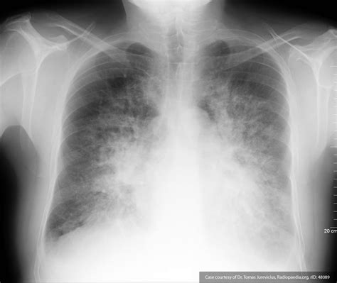 Chest X Ray Pulmonary Edema Vs Pneumonia at Beth Meeks blog