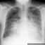 pulmonary edema 的图像结果