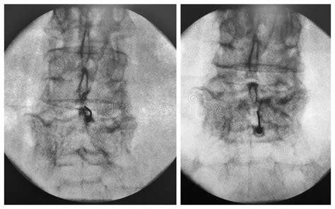 Image result for Fluoro Spinal Injection