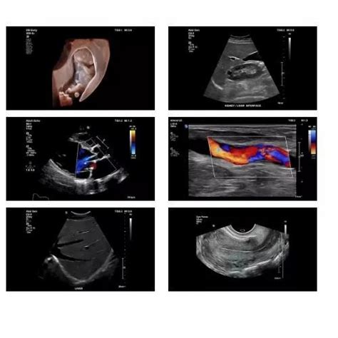 Philips Ultrasound Scanner - Philips HD7 Ultrasound Scanner Trader ...