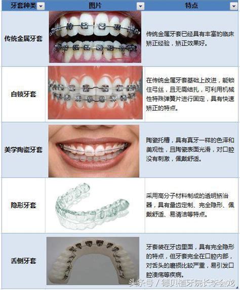 只有上牙不齐，可以只戴一半牙套吗？ - 知乎