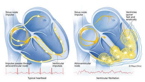 Ventricular fibrillation – White Cross Clinic