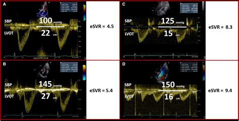 Association of Systemic Vascular Resistance Analog and Cardiovascular ...