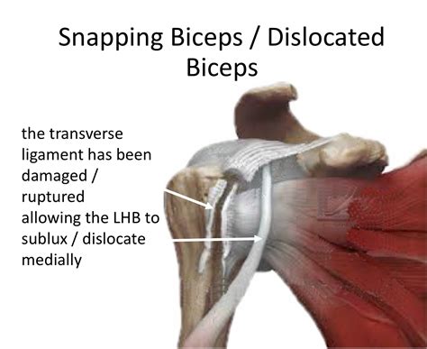 Long Head of Biceps – Cambridge Shoulder