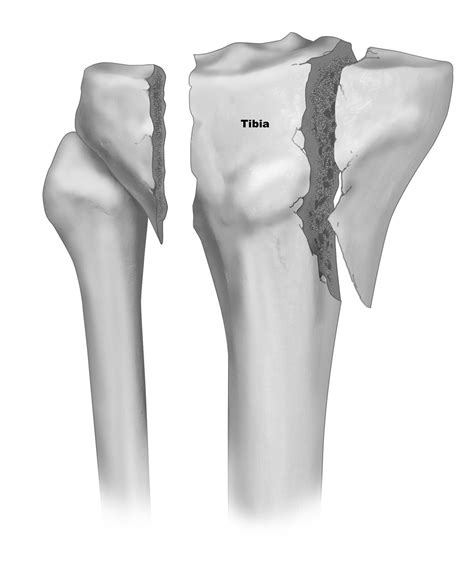Broken Tibial Plateau