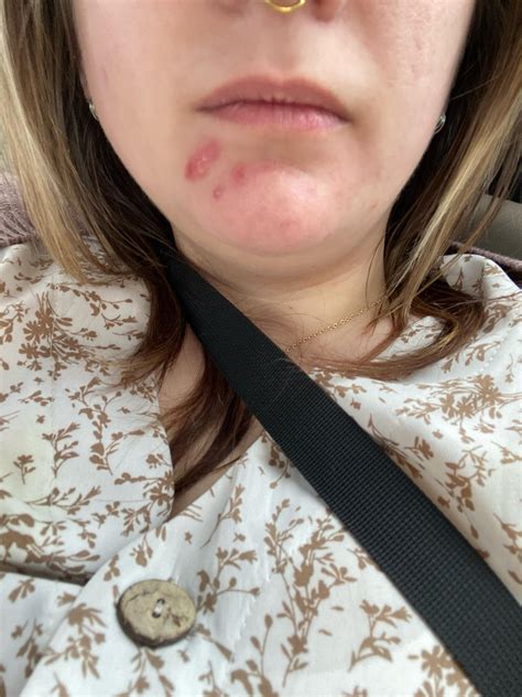 +Massive Exploding Cysts N Boils 的图像结果