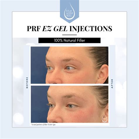 Injectable PRF 的图像结果