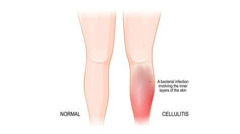 Beyond Chronic Venous Insufficiency: Understanding Cellulitis and When to Worry