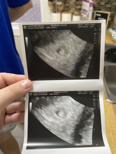 8 week ultrasound — The Bump