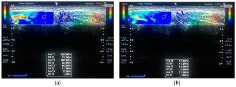 Dynamic Quantitative Imaging of the Masseter Muscles in Bruxism ...