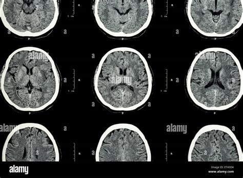 Image result for Normal Brain CT Scan Head