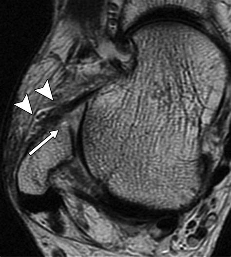 The Bright Rim Sign on MRI for Anterior Talofibular Ligament Injury ...