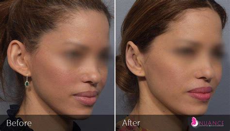 Image result for Ear Modification