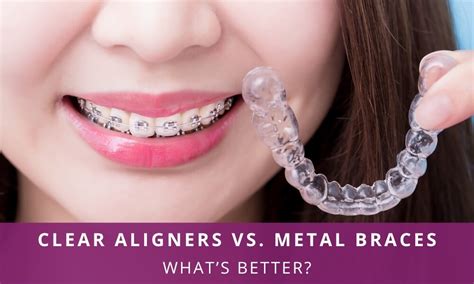 https://facesurgeon.in/wp-content/uploads/2023/07/Clear-aligners-Vs-Metal-braces.jpg