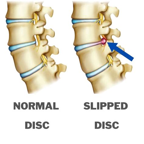 Discover How to Treat a Slipped Disc in Malaysia: Symptoms, Causes & Outcomes