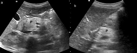 Acute pancreatitis in pancreatic-insufficient cystic fibrosis patients ...