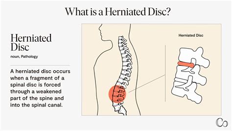 Signs a Herniated Disc Is Healing: The Ultimate Guide to Recovery ...