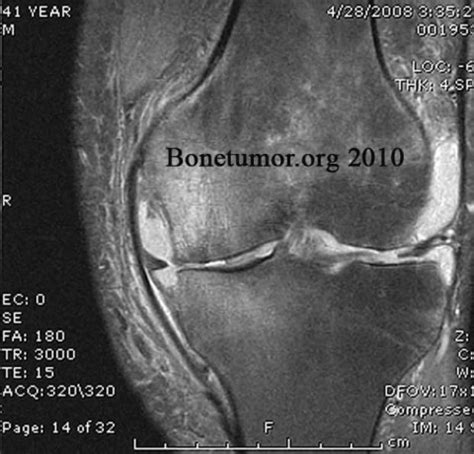 Image result for Exploding Massive Knee Abscess