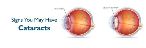Know the Signs of Cataract and Eye Health