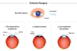Cataract Services