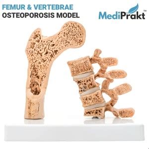 MediPrakt | FEMUR & VERTEBRAE OSTEOPOROSIS MODEL | LIFE SIZE | DISECTED ...
