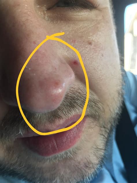 Round red spot/bump on tip of nose that sometimes get brighter red. No pain, or apparent ...