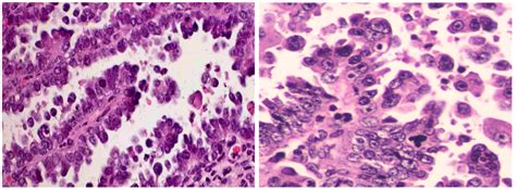 Molecular Classification of Endometrial Cancer and the 2023 FIGO ...