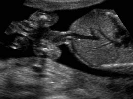 Bildergebnis für normal umbilical cord ultrasound