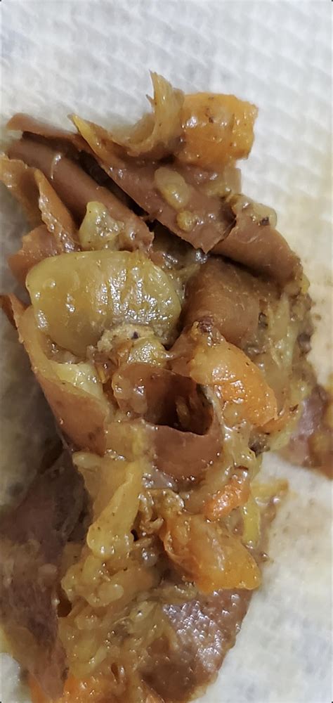 dead liver flukes in stool? : r/ClinicalMicrobiology