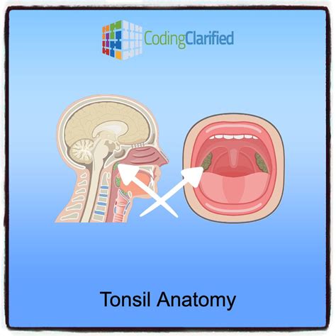 Tonsils are lymphoid tissue located in the throat and are part of the body's immune system ...
