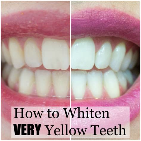 remove yellow teeth photo