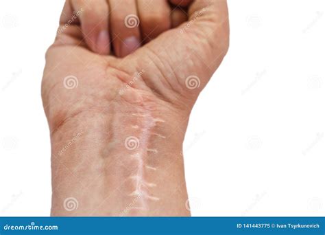 Scar with Stitches on the Wrist after Surgery. Fracture of the Bones of ...