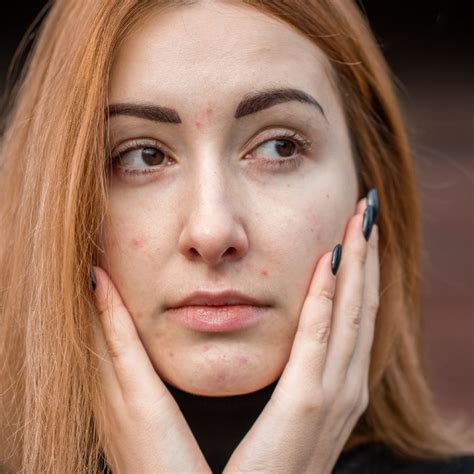 Image result for Exploding Pimples