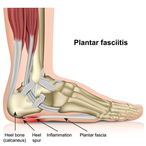 Arch Support For Plantar Fasciitis - JOI Jacksonville Orthopaedic Institute