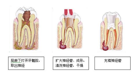 牙髓炎的症状与分类有哪些-海南口腔医院【官网】